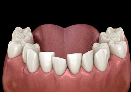 Illustration of crooked teeth