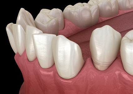 Illustration of gapped teeth