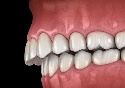 Illustration of an overbite