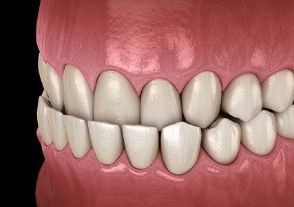 Illustration of an underbite