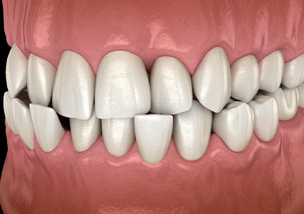 Illustration of a crossbite