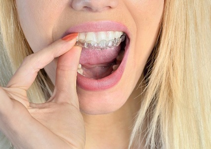 girl inserting clear aligner