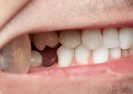 Closeup of a missing tooth