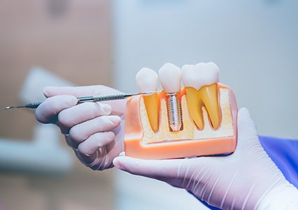 Dentist pointing to dental implant model