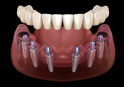 Implant-retained dentures