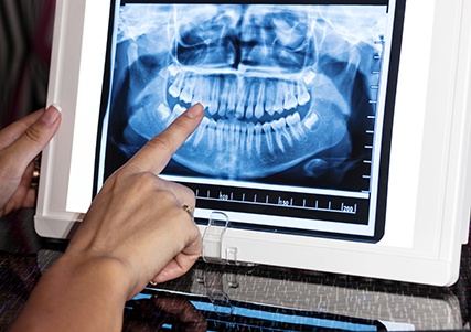Dentist reviewing patient's X-ray