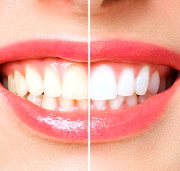 Teeth whitening before and after