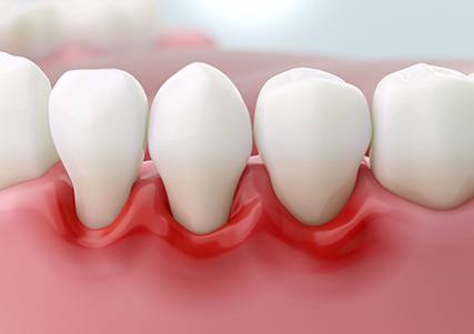 Illustration of red, inflamed gums