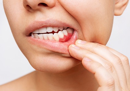 Closeup of patient with red gums