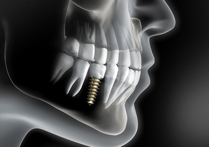 X-ray showing dental implant in Saginaw, TX in jawbone