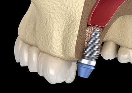 Model of a single dental implant