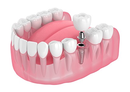 Illustration of a single dental implant