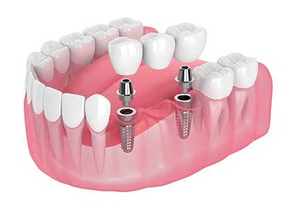 Illustration of an implant bridge
