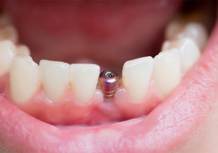 closeup of dental implant in mouth 