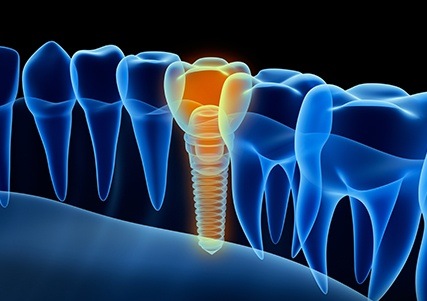 3D rendering of implant supported replacement tooth