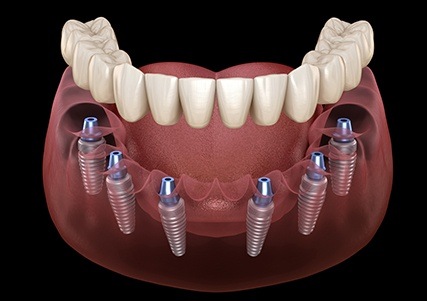 Animation of implant supported denture