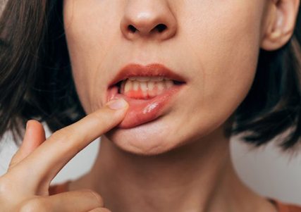 Lady shows inflamed gum tissue