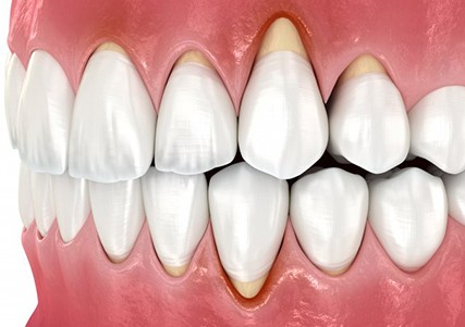Illustration of receded gums