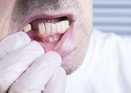 Man with a missing tooth at dental consultation.