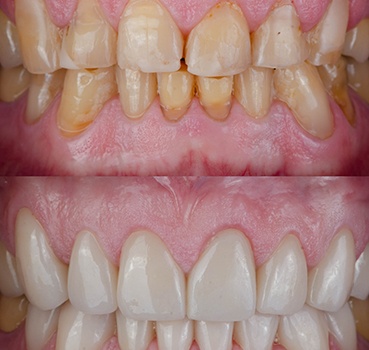 A before and after image of a person’s teeth that are severely stained and chipped