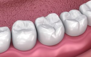 Image of tooth-colored fillings