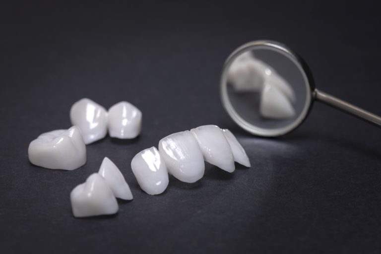 Causes of Dental Bridge Failure and How to Avoid Them