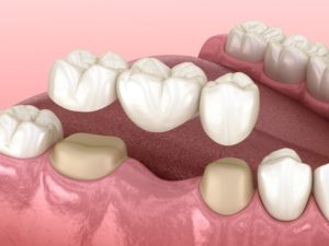 dental bridge illustration