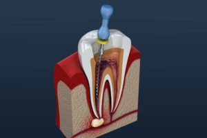 Model of a root canal