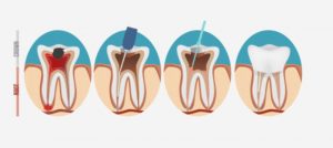 root canal illustration
