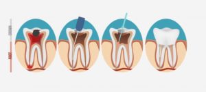 root canal illustration 