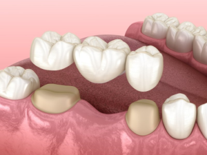 a closeup of a dental bridge