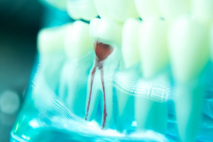 3D render of a root canal treatment