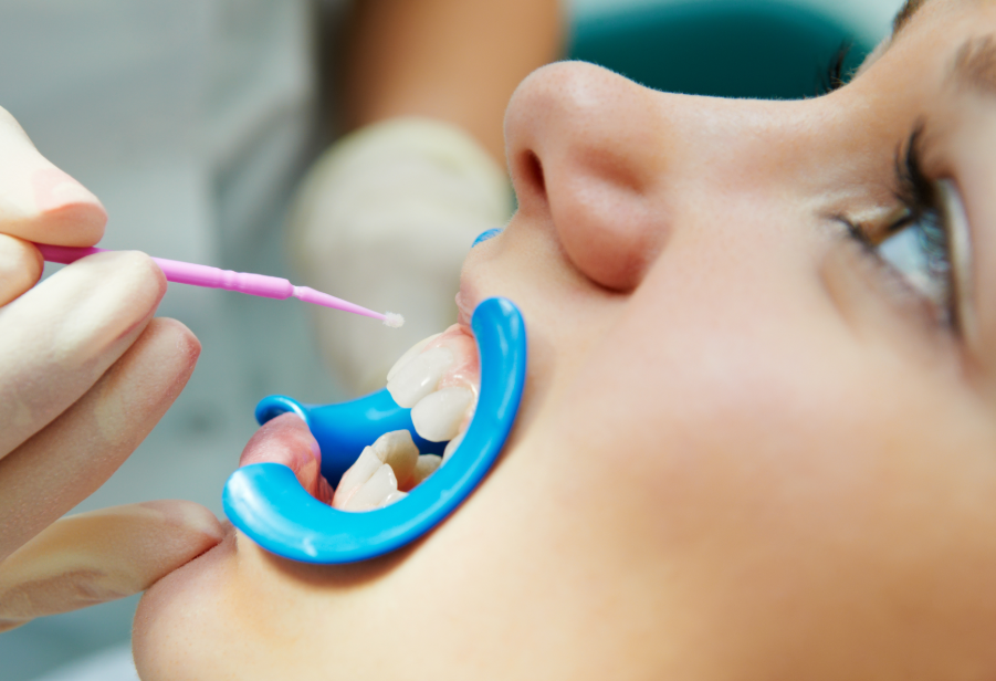 Dentist applying dental sealant on child's teeth