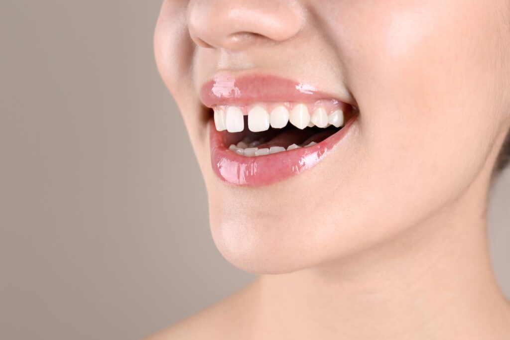 Nose-to-neck 3/4 profile view of woman smiling with diastema