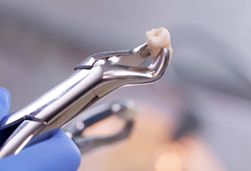 Tooth on forceps
